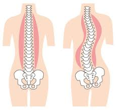 側湾症は“骨の勘違いも